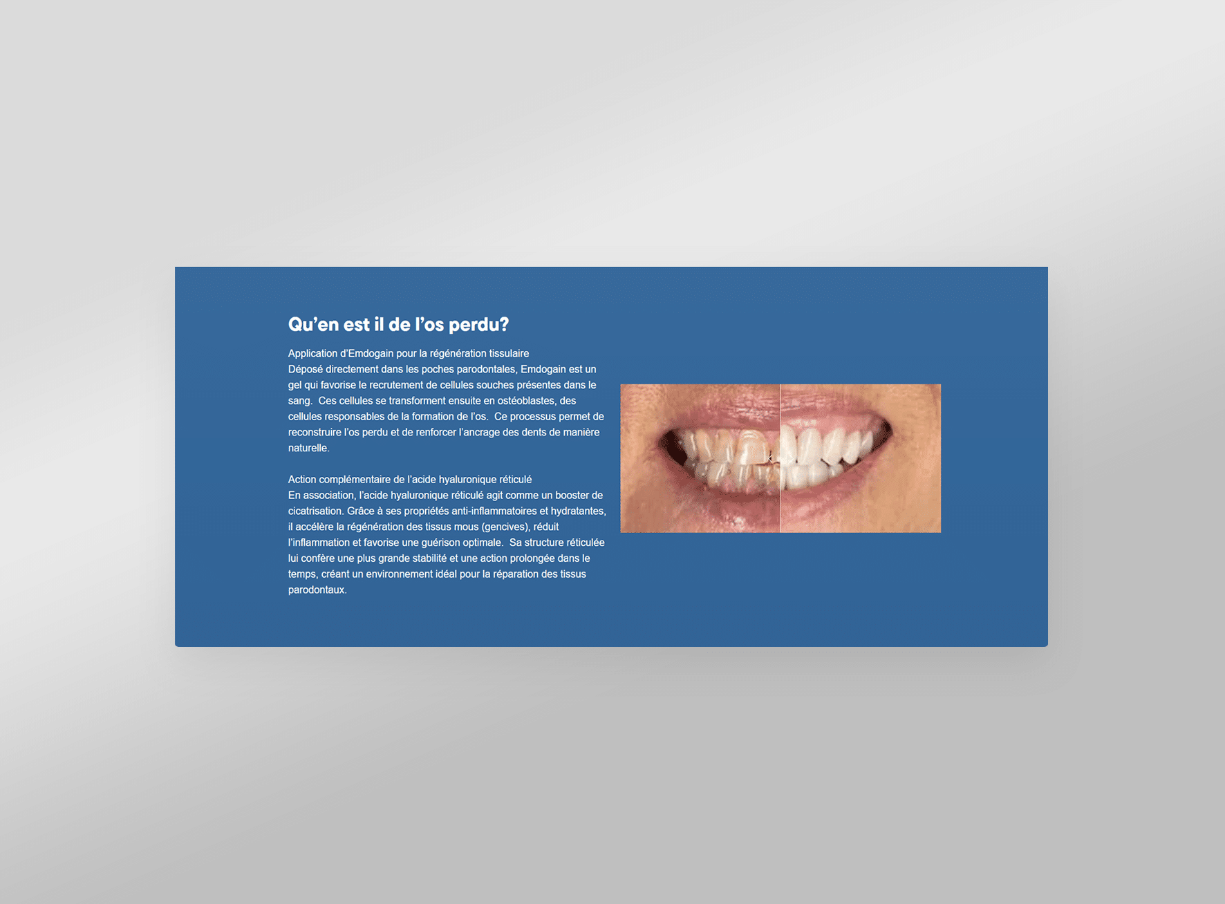 De slider voor de before and after van de ParodontologieRevolut website